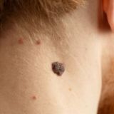 Теперь ясно, как избавиться от бородавок / Народные методы / Вот что делали наши бабушки!